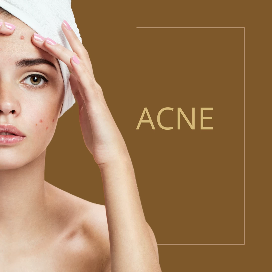 6 FATORES QUE PODEM AGRAVAR A ACNE | Dra. Nátalli Landi